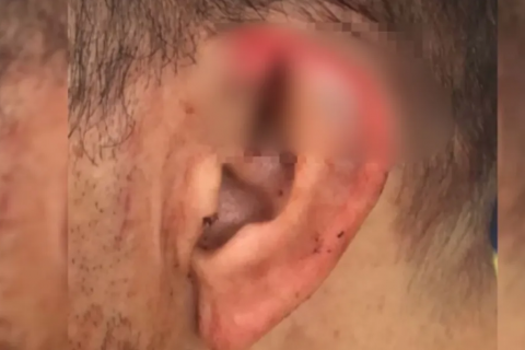 Homem morde e arranca pedaço de orelha do namorado durante discussão